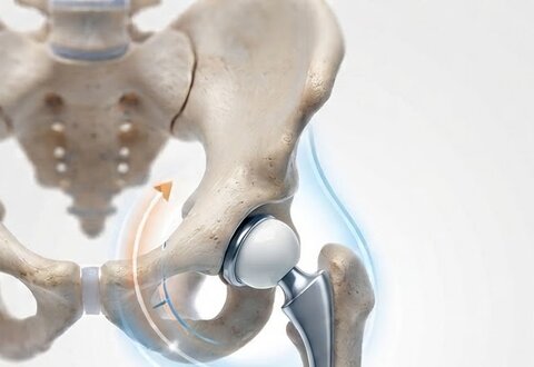 Hip Replacement — Direct Anterior Approach illustration