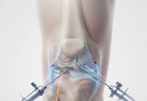 Knee Arthroscopy illustration