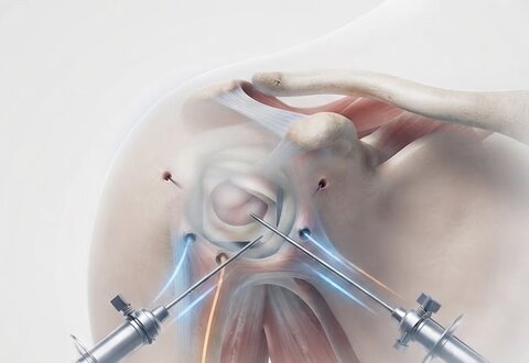 Shoulder Arthroscopy illustration