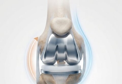Total Knee Replacement illustration